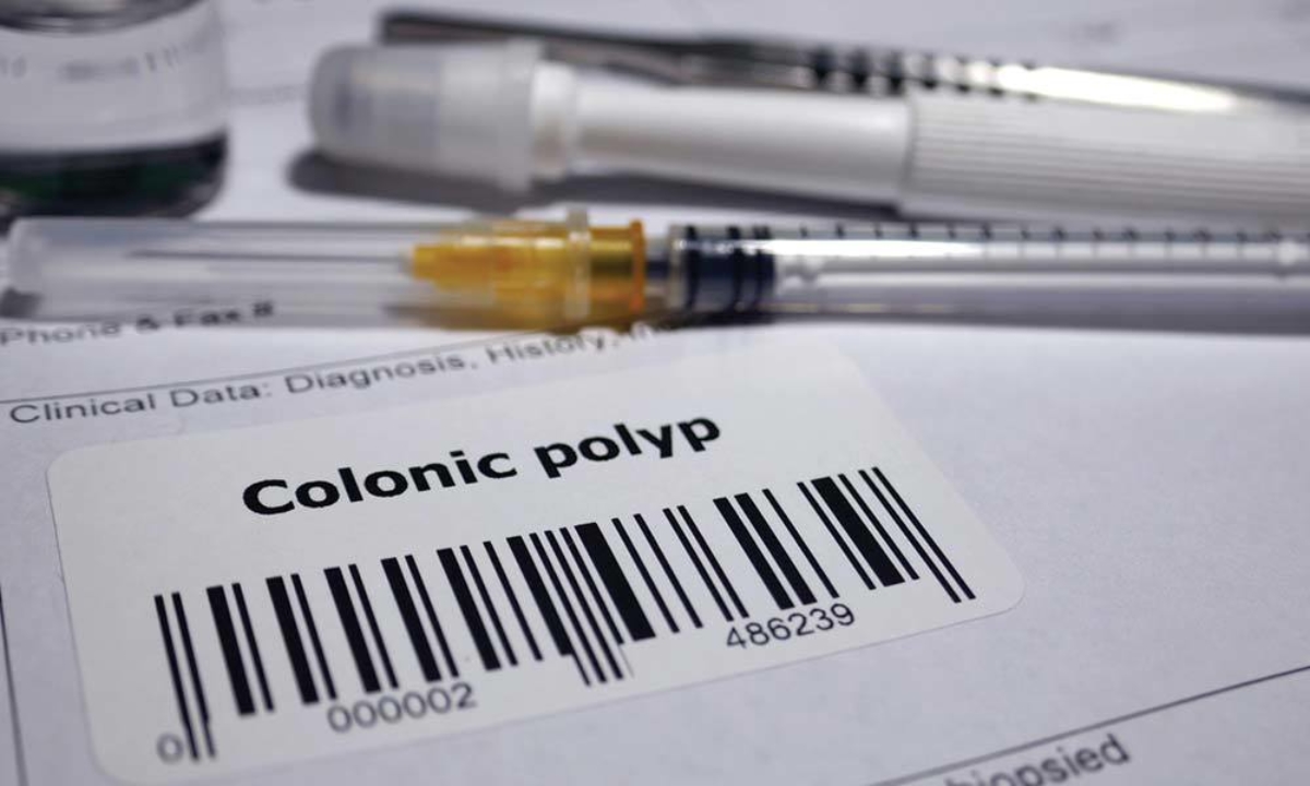 Colon Polyps Causes Symptoms Cary Gastroenterology Associates