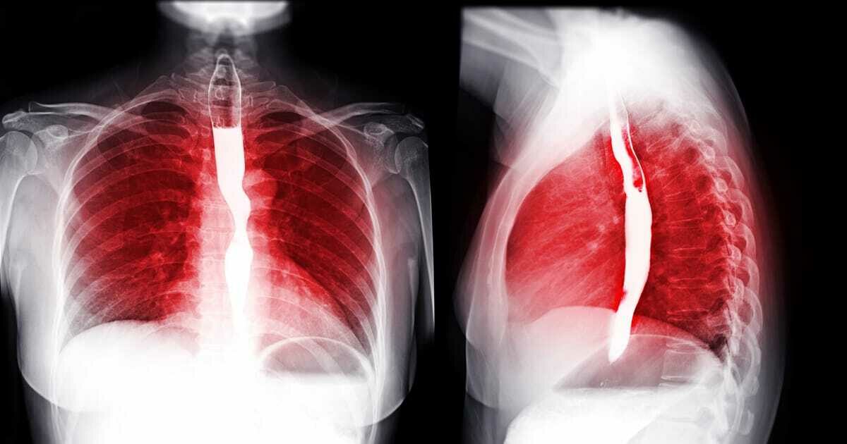 Cary Gastroenterology Associates Why Might I Need a Barium Swallow…