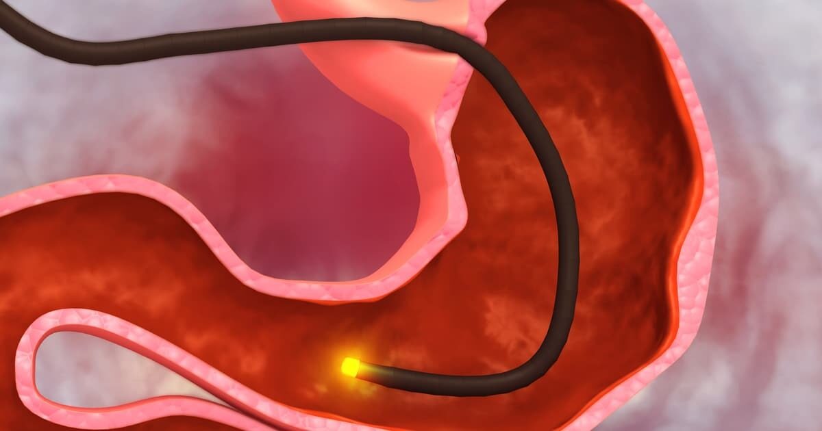Cary gastroenterology associates reasons you might need a stomach 
