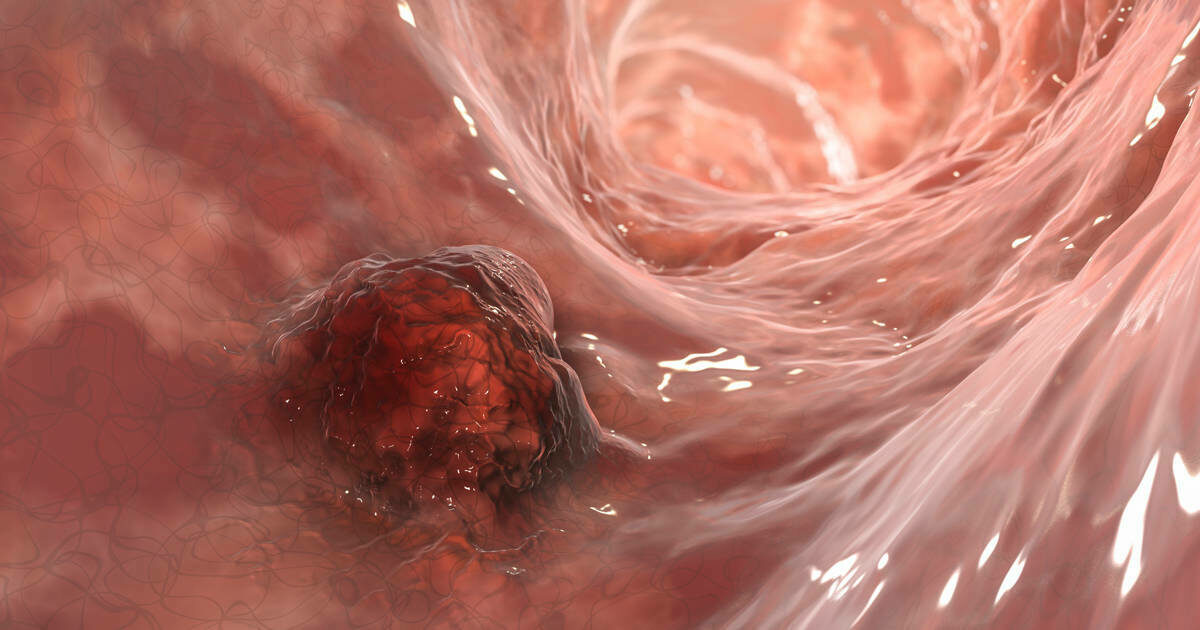 cary-gastroenterology-associates-gastrointestinal-stromal-tumors