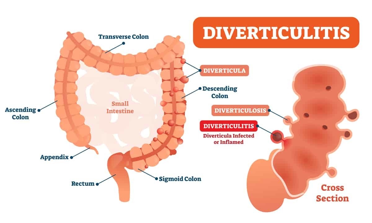 can diverticulosis pockets go away with proper diet