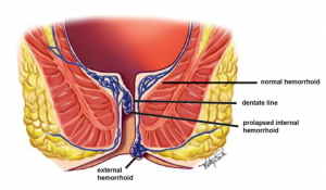 Hemorrhoid Types